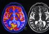 Что может показать МРТ головного мозга?