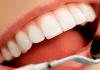 Что такое виниры — плюсы и минусы винирования зубов Что такое виниры для зубов в домашних