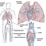 Тромбоэмболия легочной артерии смерть