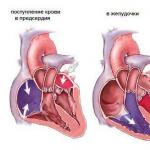 Стеноз лёгочной артерии у детей