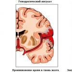 Чем опасно кровоизлияние в мозг у новорожденных?